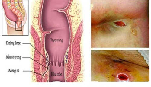 Rò dịch hậu môn